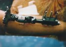 Picture if an external fixator.  Yes, those screws are screwed into the bone in my leg.  I also had a nice row of staples too.